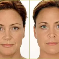 Zmarszczki palacza: Botox czy kwas hialuronowy - co wybrać?