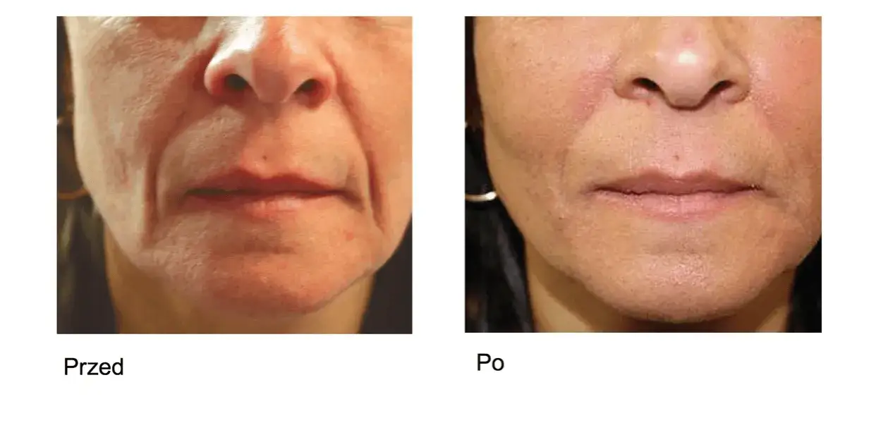 Zdjęcie Zmarszczki palacza: Botox czy kwas hialuronowy - co wybrać?